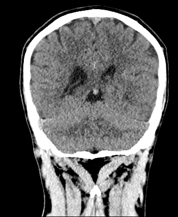 Coronal