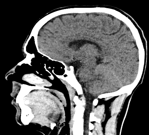 Sagittal